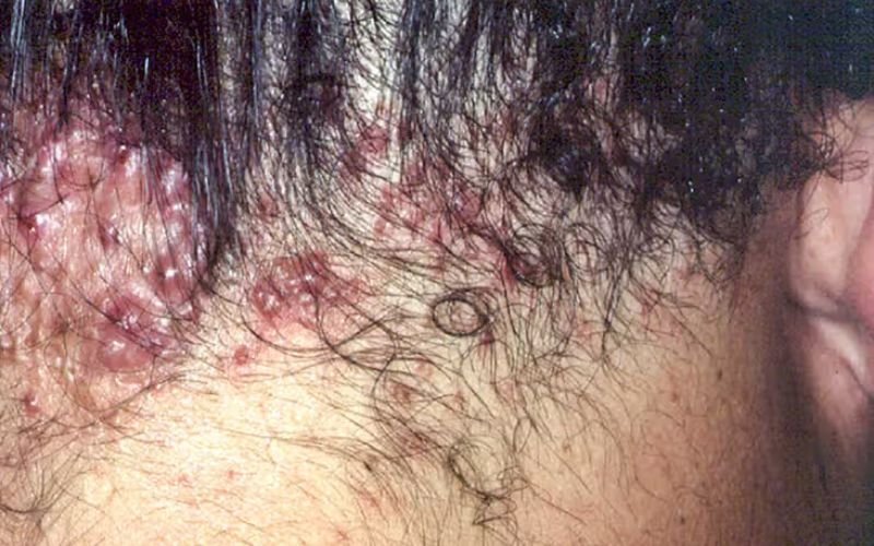 acne keloidalis nuchae
